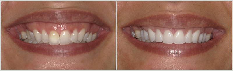 Before and After Cosmetic Dentistry