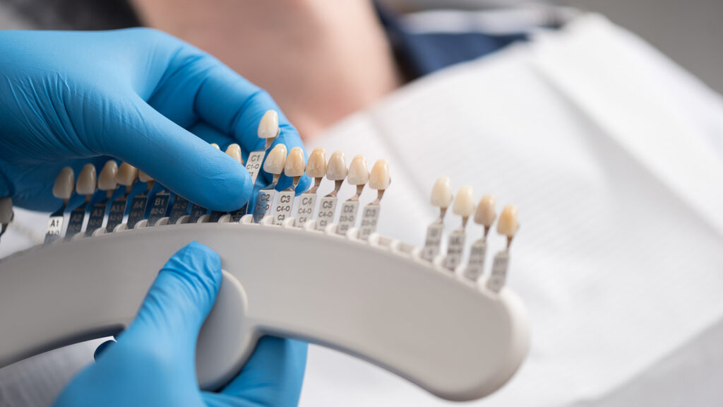 A dentist holding a shade guide to select the perfect color for dental veneers, ensuring a natural and seamless smile for the patient.