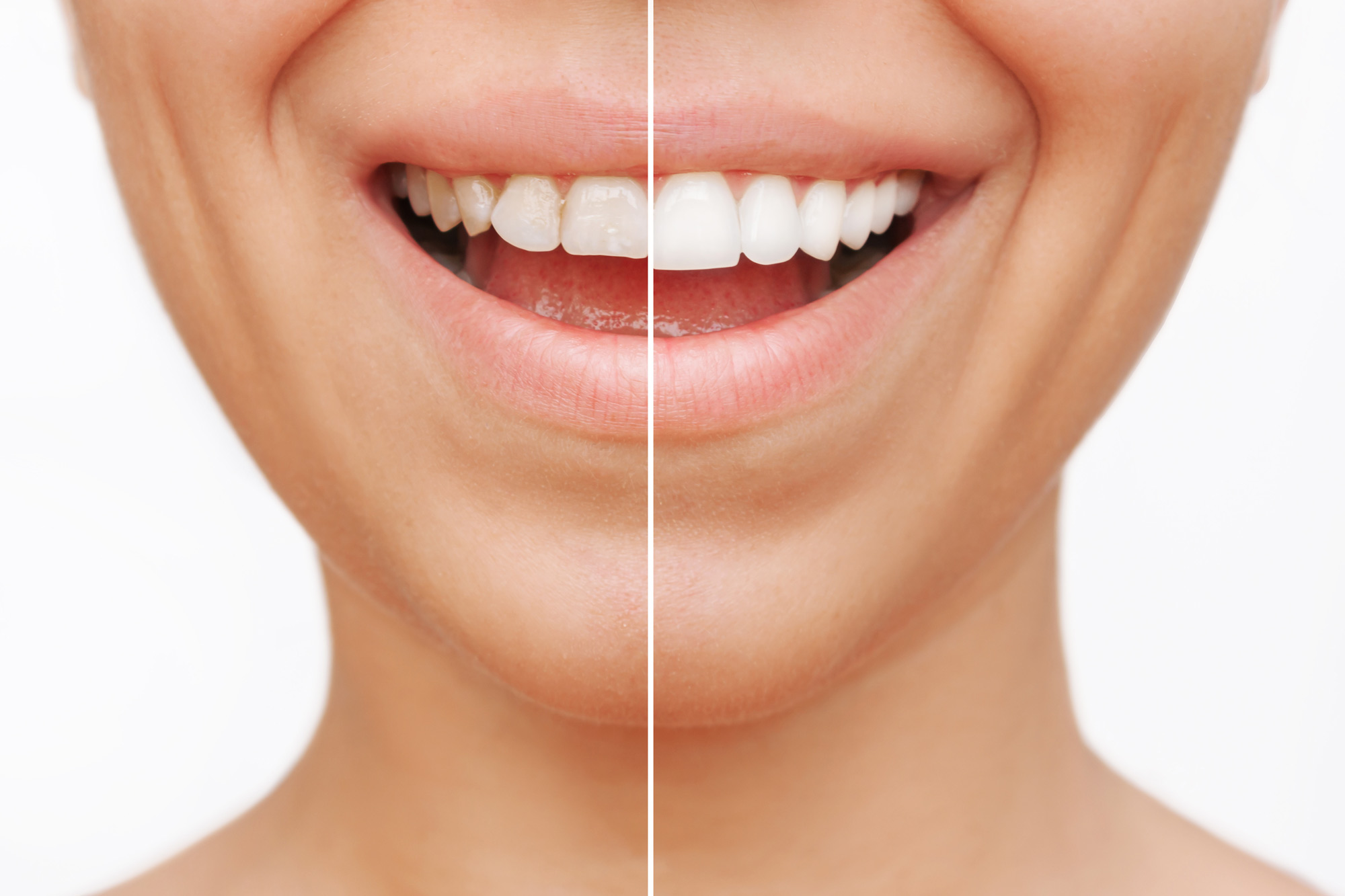 A before-and-after comparison of a smile, showcasing the transformative effects of dental veneers for a brighter and more confident appearance.