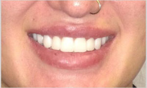 Happy Smile AFTER Cosmetic Dentistry