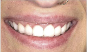 Unhappy Smile BEFORE Cosmetic Dentistry